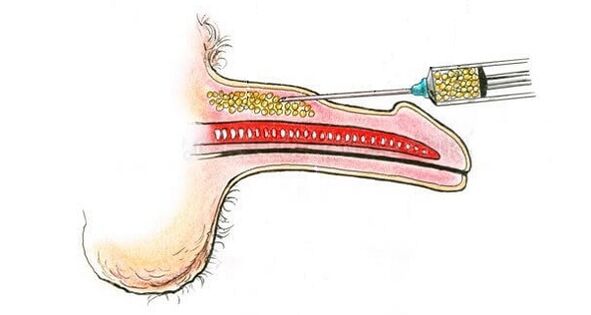 Injections d'acide hyaluronique au cours d'un membre pour l'augmenter